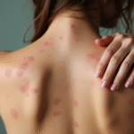 Bolivia Declares Health Emergency Over Rising Cases of Measles