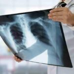 Tuberculosis Cases Drop for First Time Since Pandemic, Yet 1.23 Million Deaths Reported: WHO Warns of Funding Cuts Threatening Progress